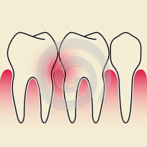 Periodontal Disease