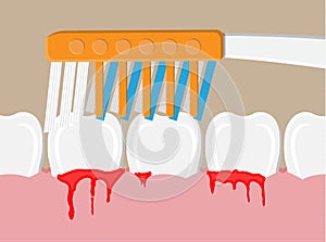 Periodontal disease, bleeding gums