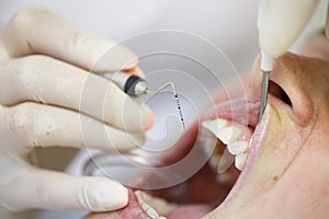 Periodontal probe for measuring pocket depths photo