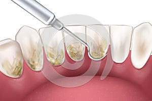 Periodontal Scaling and Root Planing. Oral hygiene and conventional periodontal therapy. Medically accurate of human