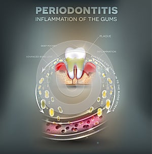 Periodontitis