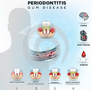 Periodontitis bacteria cause disease photo