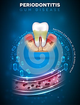 Periodontitis bacteria enters in to the blood photo