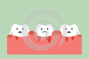 Periodontitis and bleeding photo