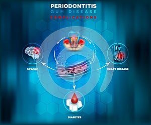 Periodontitis complications poster photo