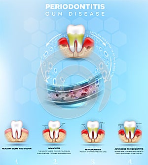 Periodontitis gum disease