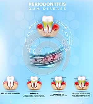 Periodontitis gum disease photo