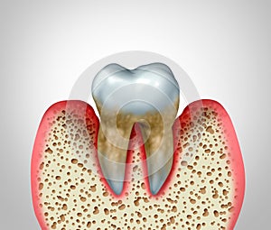 Periodontitis photo