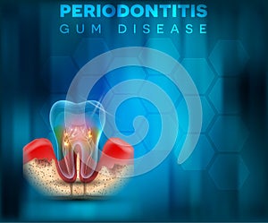 Periodontitis gum disease poster