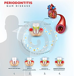 Periodontitis gum disease problems