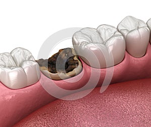 Periodontitis and gum inflammation. Medically accurate dental 3D illustration