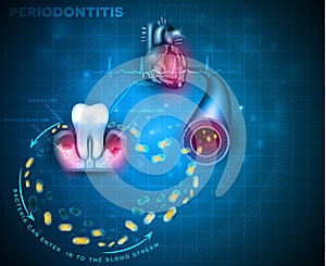 Periodontitis and heart problems photo