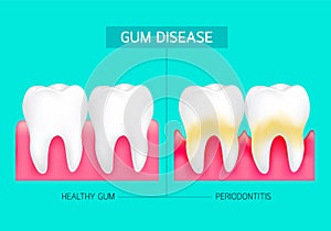 Periodontitis and inflammation of the gums.