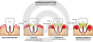 Periodontitis photo