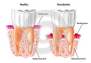 Periodontitis photo