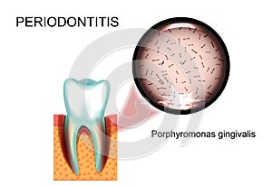 Periodontitis. Porphyromonas gingivalis