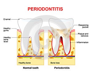 Periodontitis or pyorrhea