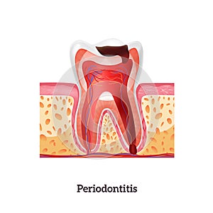 Periodontitis Realistic Illustration