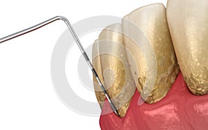 Periodontitis testing, gum recession process. Medically accurate 3D illustration