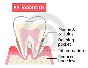 periodontitis tooth and gums. periodontal pocket and bone destruction. Dental and oral care concept