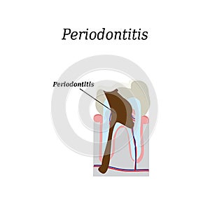 Periodontitis tooth. Vector illustration on