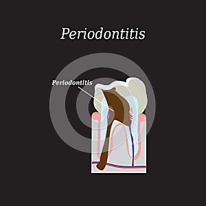 Periodontitis tooth. Vector illustration on a