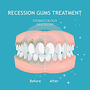 Periodontitis vector banner. Recession gums treatment. Stomatology dentistry concept