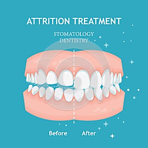 Periodontitis vector banner. Recession gums treatment. Stomatology dentistry conceptAttrition treatment vector. Stomatology dentis