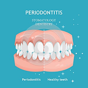 Periodontitis vector. Recession gums treatment. Stomatology dentistry concept