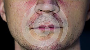 Perioral dermatitis - skin disease on the face photo