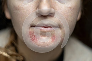 Perioral dermatitis on woman face. Closeup dermatitis on skin, ill allergic rash eczema skin of patient, atopic