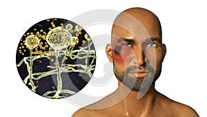 Periorbital cutaneous mucormycosis, a disease caused by Mucor fungi