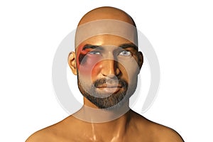 Periorbital cutaneous mucormycosis, a disease caused by Mucor fungi photo