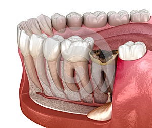 Periostitis tooth - Lump on Gum Above Tooth. Medically accurate dental 3D illustration