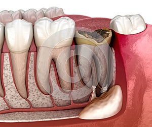 Periostitis tooth - Lump on Gum Above Tooth. Medically accurate dental 3D illustration