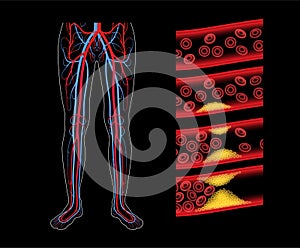 Peripheral artery disease