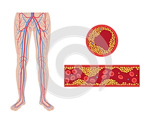 Peripheral artery disease