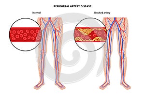 Peripheral artery disease