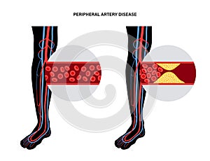 Peripheral artery disease