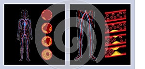 Peripheral artery disease