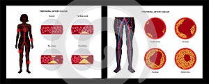 Peripheral artery disease