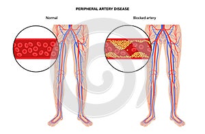 Peripheral artery disease photo