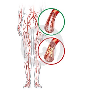 Peripheral artery occlusive disease, intermittent claudication, medical illustration photo