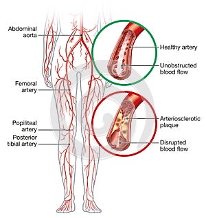 Peripheral artery occlusive disease, intermittent claudication, medical illustration photo