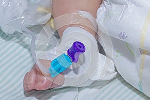 Peripheral intravenous catheter in the vein of newborn baby foot