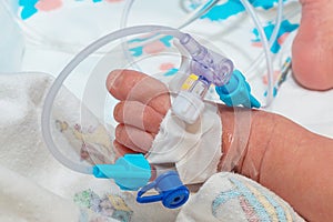 Peripheral intravenous catheter in the vein of newborn baby foot