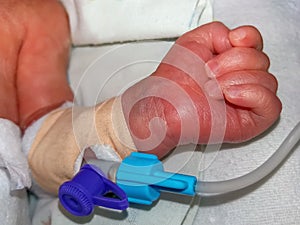 Peripheral intravenous catheter in the vein of newborn baby hand