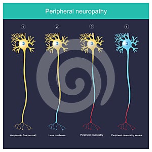 Peripheral neuropathy.  Explain illustration for The Peripheral neuropathy photo
