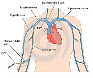 A peripherally inserted central catheter