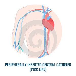 Peripherally inserted central catheter PICC line close up